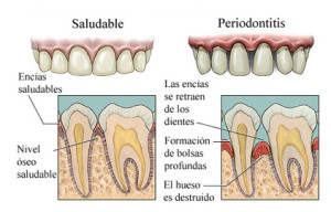 enfermedad-periodontal